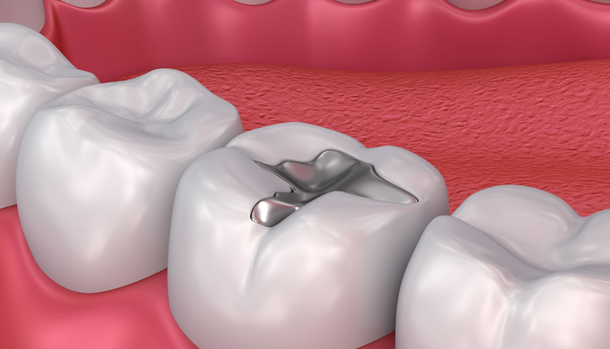 Understanding Cavity Fillings: What You Need to Know