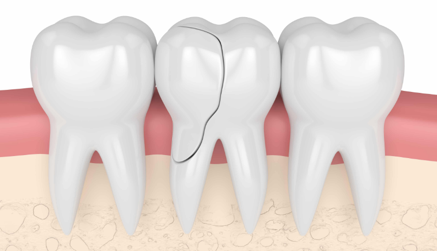 Fractured Tooth