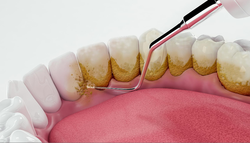 Scaling and Polishing