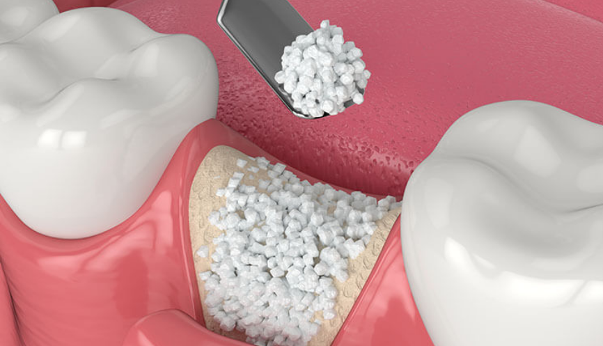 Bone Graft