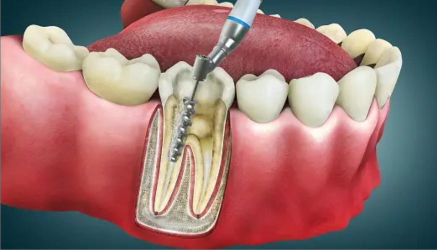 Painless Root canal Treatment