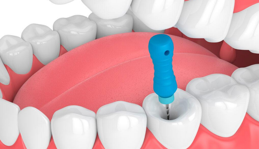 Single Sitting Root canal Treatment